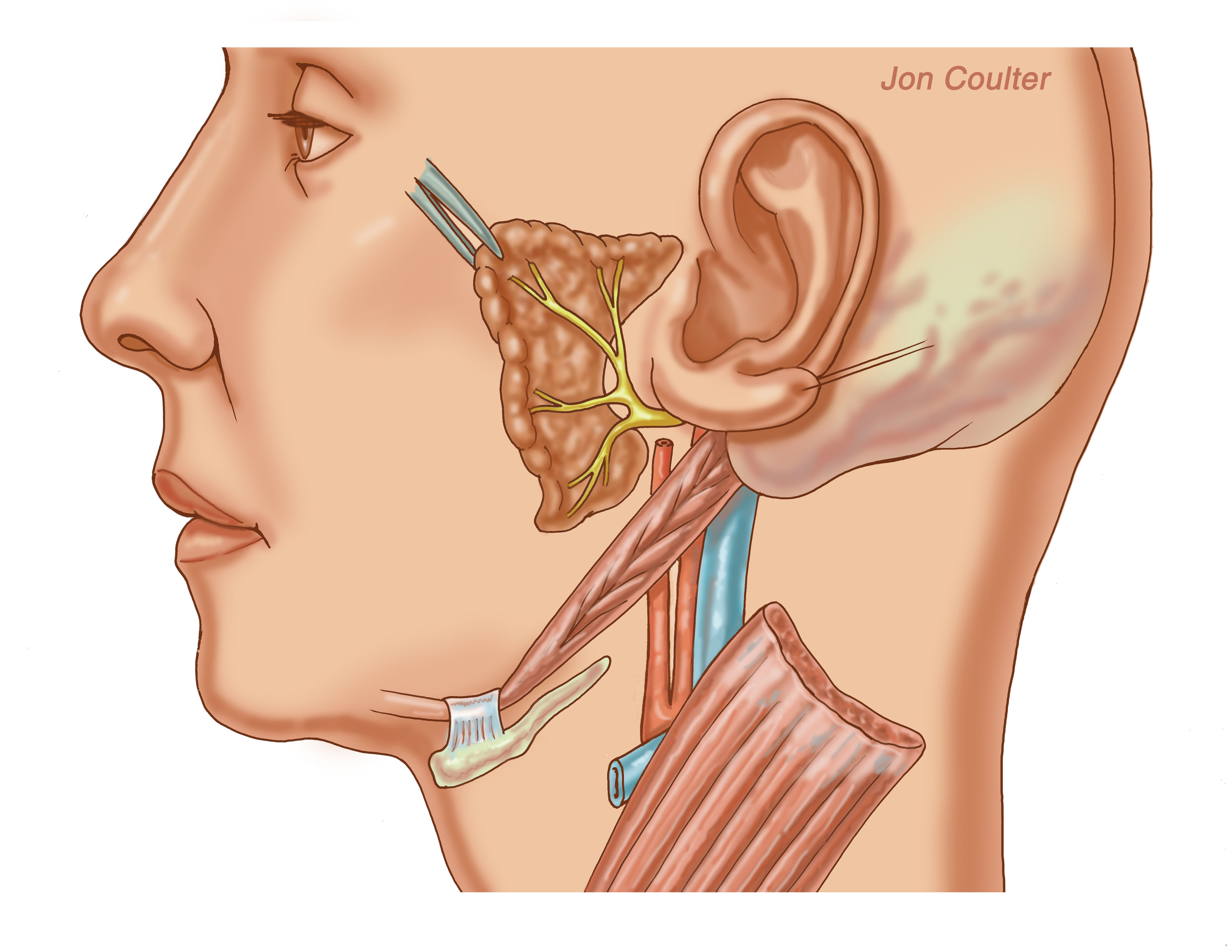 Воспаление ушного нерва