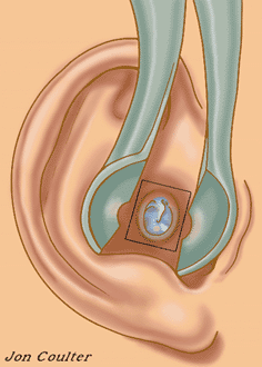 What are the symptoms of a burst eardrum?
